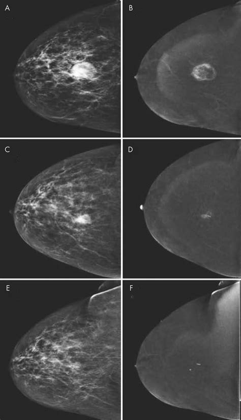 Contrast Enhanced Mammography State Of The Art Radiology