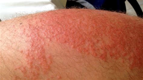 Itchy Skin Rash All Over Body Body Choices