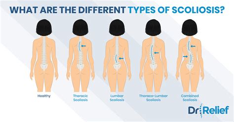 How many different types of chart exist and how are they used in project management? Different types of back pain - ALQURUMRESORT.COM