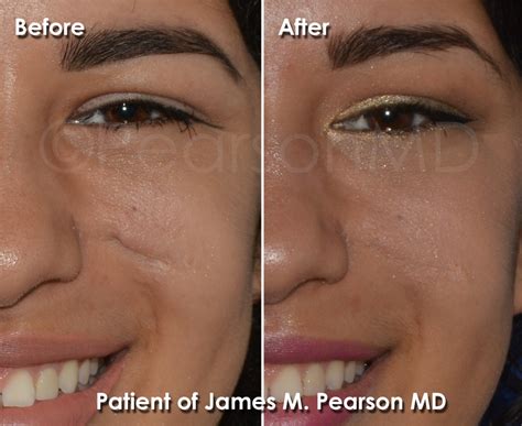 Scar Revision Photos Before And After Dr James Pearson Facial