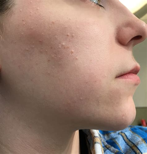 Skin Colored Bumps On Face Not Acne Naturalskins