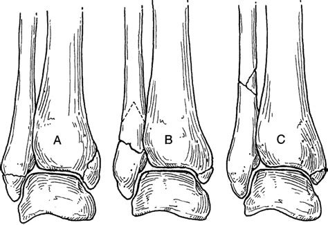 Drawings Illustrate The Weber Danis Weber Classification Of Ankle