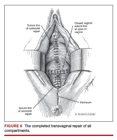 Native Tissue Repair Of POP Surgical Techniques To Improve Outcomes MDedge ObGyn