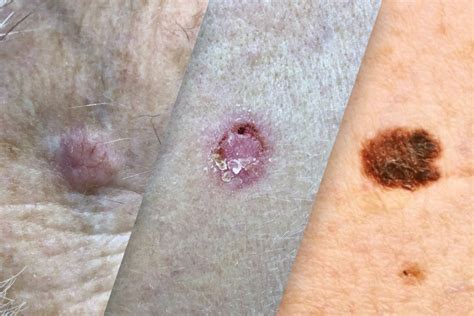 Types Of Skin Cancer And Treatment Options Skin Cancer Guide