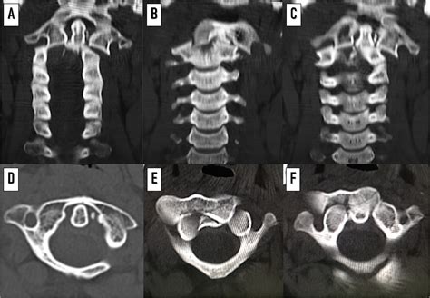Acute Traumatic Lateral Atlantoaxial Dislocation Associated With Locked