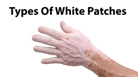 White Patches On Skin White Spots On Skin Pictures Causes And