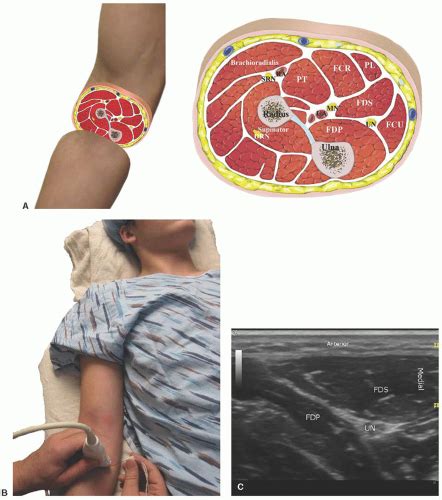 Ultrasound Guided Blocks At The Elbow And Forearm Anesthesia Key