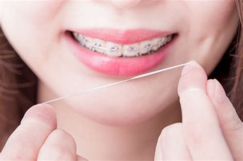 4 tips for easy flossing with braces shirck orthodontics ohio orthodontists