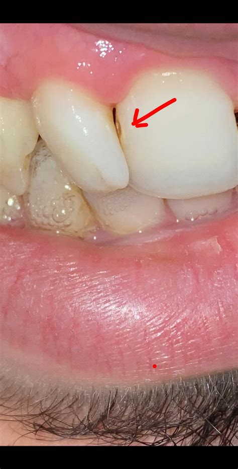 Sometimes mild stains are visible once braces are removed, but it's not. I noticed a hole between my front teeth. Is this a cavity ...