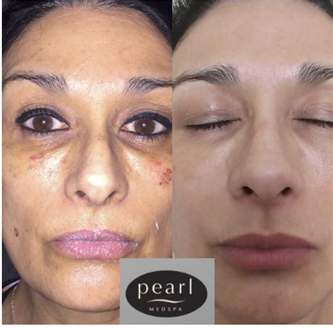 Ipl Photofacial Pearl Medspa