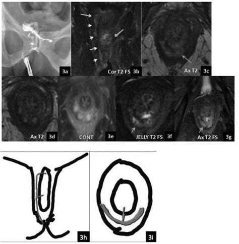 Scielo Brasil Magnetic Resonance Imaging Of Perianal Fistulas In Clinically Symptomatic