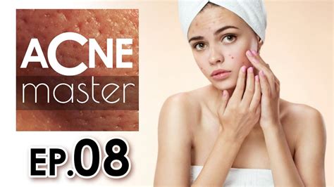 Cystic Acne Acne Treatment And How To Remove Blackheads And Whiteheads