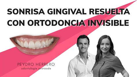 Sonrisa Gingival Resuelta Con Ortodoncia Invisible Youtube