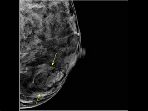 Breast And Axilla 5 1 Benign Lesions Case 5 1 7 Lipomas