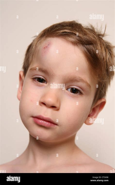 Child With Hematoma Stock Photo Alamy