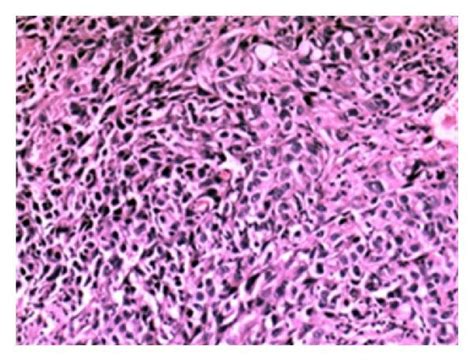 Histopathological Examination Revealed Squamous Cell Carcinoma Of The