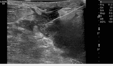 Ultrasound Guided Aspiration Of The Fluid Collection Using 18g Needle