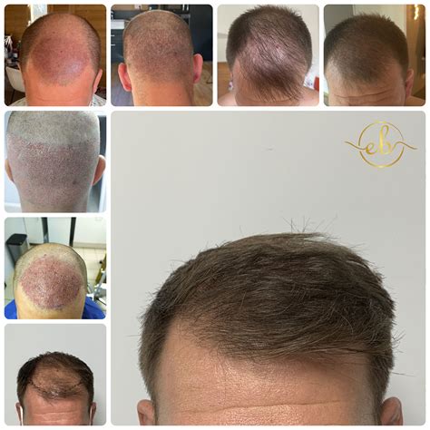 Details More Than 79 Hair Transplant Images Best In Eteachers