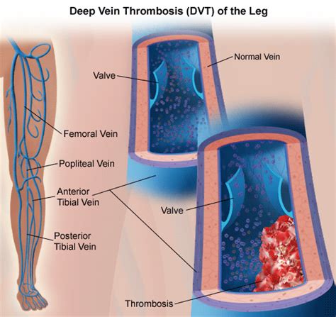 Deep Vein Thrombosis Therapeutic Dilemmas Drsvenkatesan Md