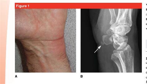 Figure 1 From Calcium Deposits In The Hand And Wrist Semantic Scholar