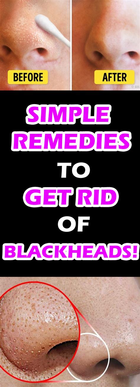 Simple Remedies To Get Rid Of Blackheads Healthy Plan Only Natural