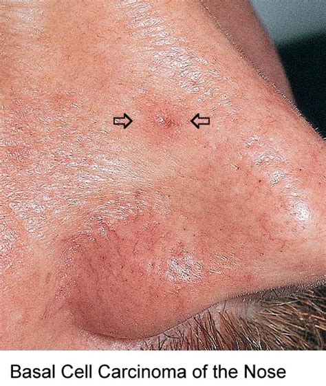 Symptoms Of Cancer Of Nose Symptoms