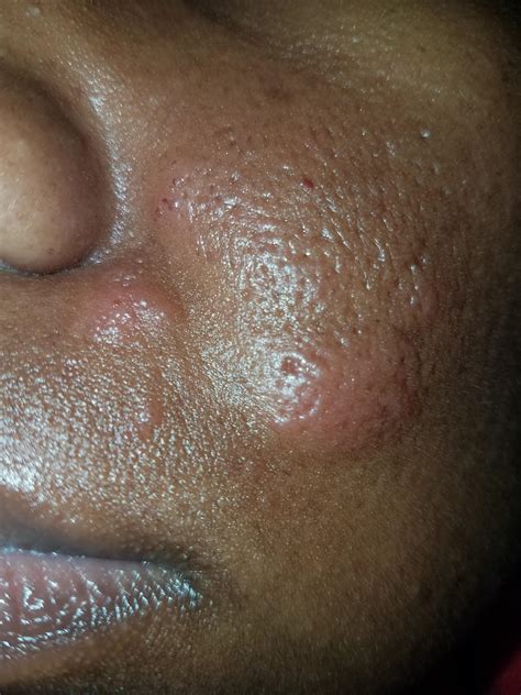 Staph Infection Or Cystic Acne Adult Acne By Edcorbin