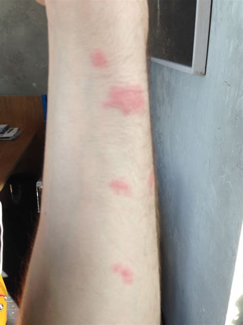 Are These Bed Bug Bites Allergy Skin Blood Swelling Health And Images And Photos Finder