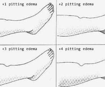 Pitting Edema Scale Grading Assessment Guide