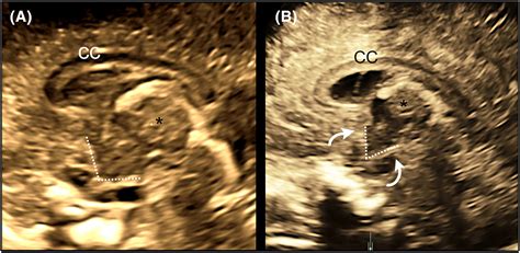 The Third Ventricle Of The Human Fetal Brain Normative Data And