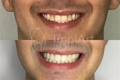 Lente De Contato Dental Especialista Da Cl Nica Implart