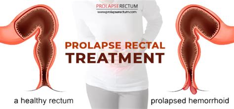 prolapse rectal treatment in india
