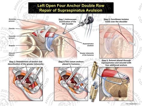 Left Open Four Anchor Double Row Repair Of Supraspinatus Avulsion