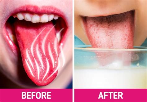 10 Ways To Heal A Burnt Tongue After Eating Hot Food Artofit