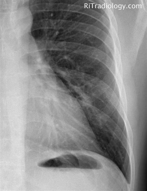 Rit Radiology Lucencies And Cavitation In Bronchioloalveolar Carcinoma