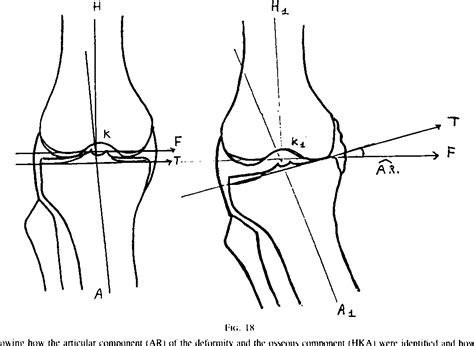 Figure 1 From Proximal Tibial Osteotomy For Osteoarthritis With Varus
