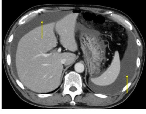 Ct Imaging Findings Of Fluid Collection In Peritoneal Cavity Arrows