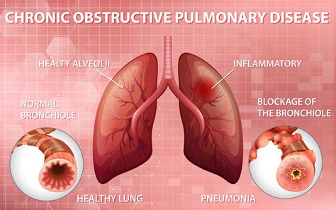 Diagrama Educacional De Doen A Pulmonar Obstrutiva Cr Nica Vetor No Vecteezy