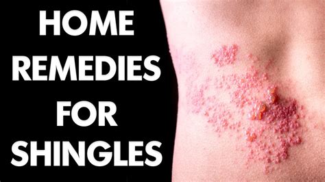Best Home Remedies For Shingles How To Treat Shingles Youtube