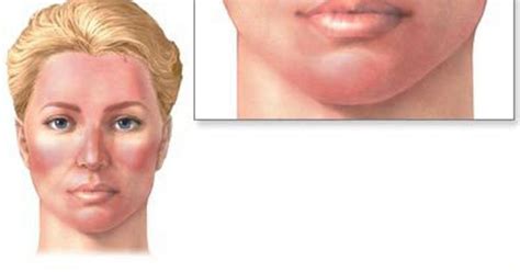 4 Simple Remedies To Treat Rosacea Facial Redness And Broken Capillaries