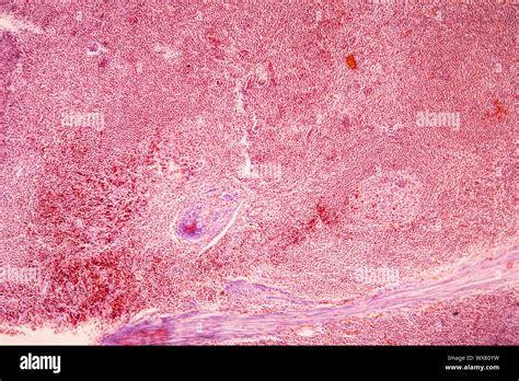 Tonsillitis Diseased Tissue Under The Microscope 100x Stock Photo Alamy