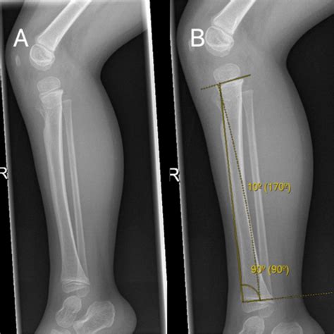 Trampoline Related Proximal Tibia Impaction Fractures In Children A