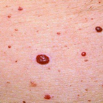 It is said that the average 30 years old will have at least one blood spot and some people are more prone to them than others. 87 best images about Clinical Diagnosis on Pinterest ...
