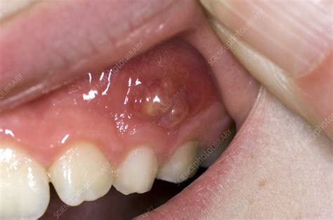 Dental Abscess In A Child Stock Image C0083595 Science Photo Library