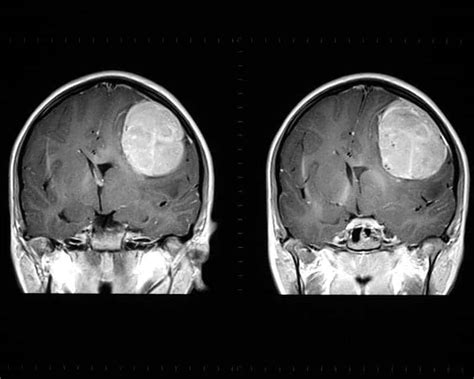 Peering Into The Genome Of A Brain Tumor Axis Imaging News