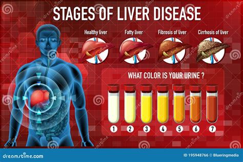 What Are The 5 Stages Of Liver Disease
