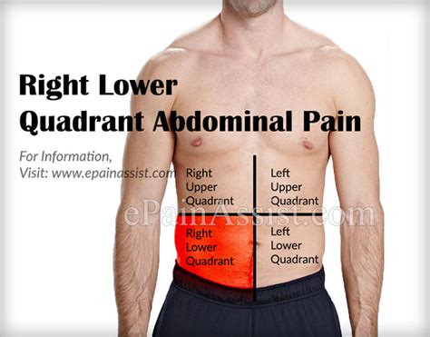 What Can Cause Right Lower Quadrant Abdominal Pain And How