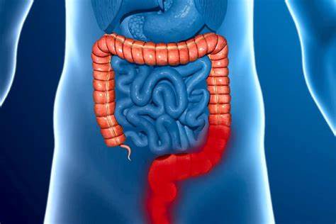 Воспаление кишечника диеты Причиной воспалительных заболеваний кишечника может быть микропластик Причиной воспалительных заболеваний кишечника может быть микропластик Воспаление кишечника диеты