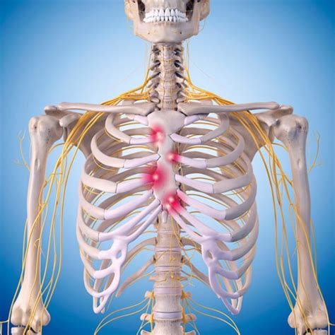 What Is Costochondritis Physiolife Images And Photos Finder