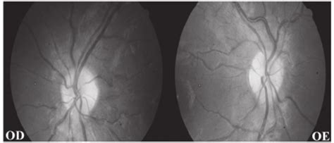 Eyegrounds Showing Bilateral Papilledema Download Scientific Diagram